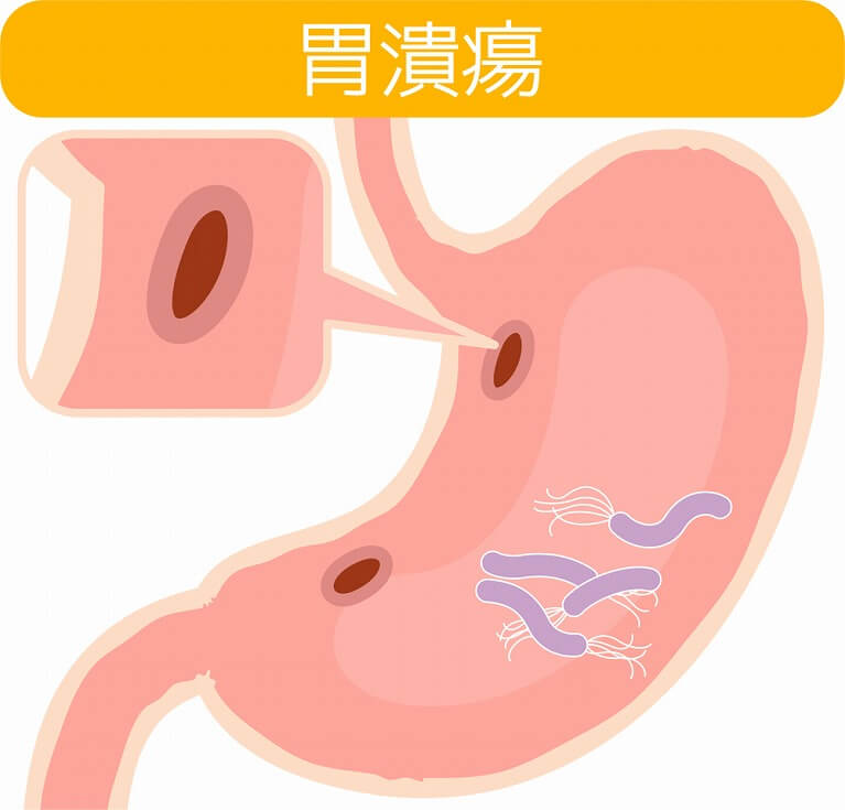 黒い便 タール便 の原因は 食べ物のせい 四條畷市の きたいクリニック