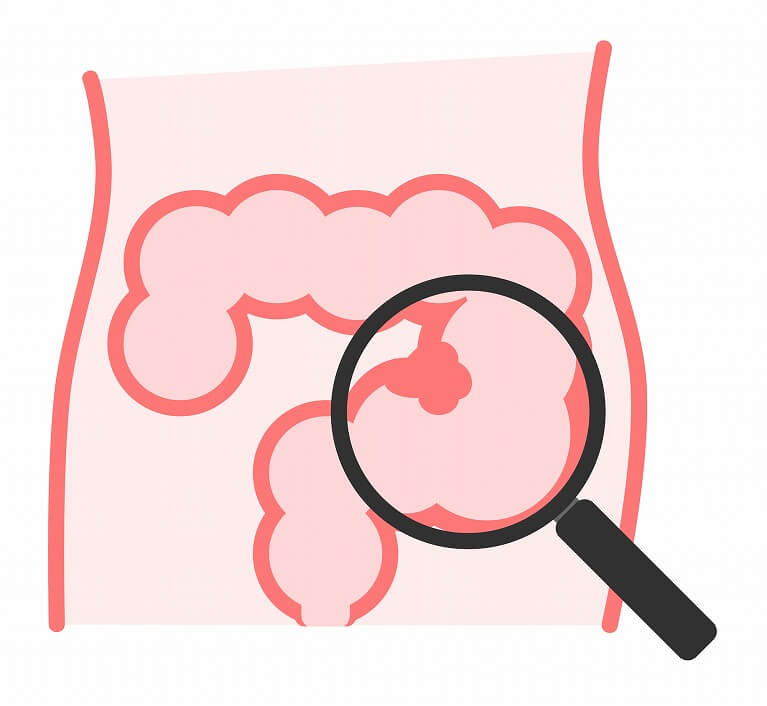 大腸内視鏡検査でわかる病気