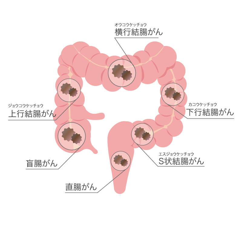 大腸 癌 便 の 細 さ